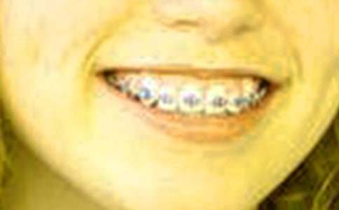 第一次戴牙套600字敘事作文(精選23篇)